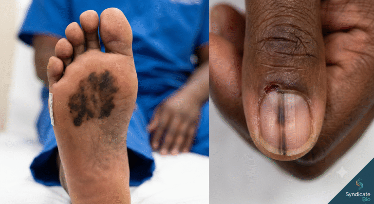 A split clinical image illustrating how Melanoma in Nigeria presents on dark skin tones, showing an irregular dark lesion on the sole of a foot (left) and a dark streak under a fingernail (right).